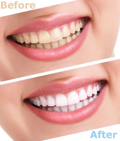 teeth whitening Raleigh NC